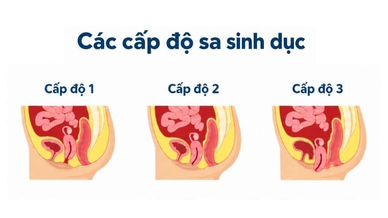 Các cấp độ sa sinh dục, từ tử cung ở vị trí bình thường đến sa hoàn toàn ra ngoài âm hộ.
