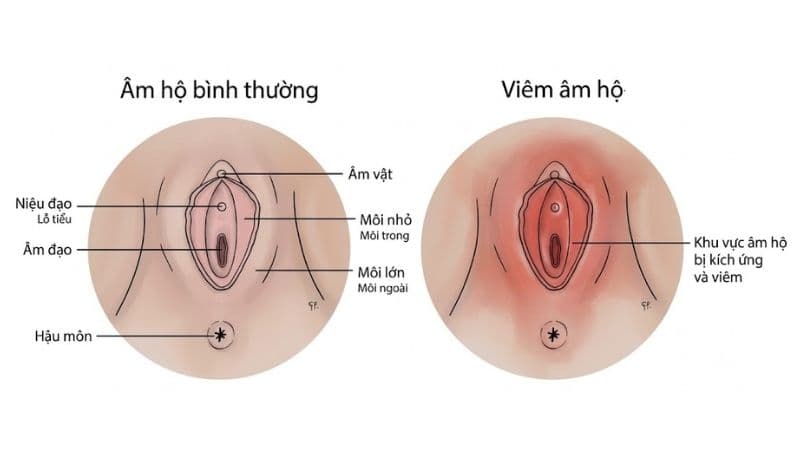 Viêm âm hộ cấp thường gây đỏ, sưng, ngứa và đau rát vùng kín.