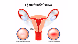 Viêm lộ tuyến cổ tử cung là gì? Có nguy hiểm hay không?