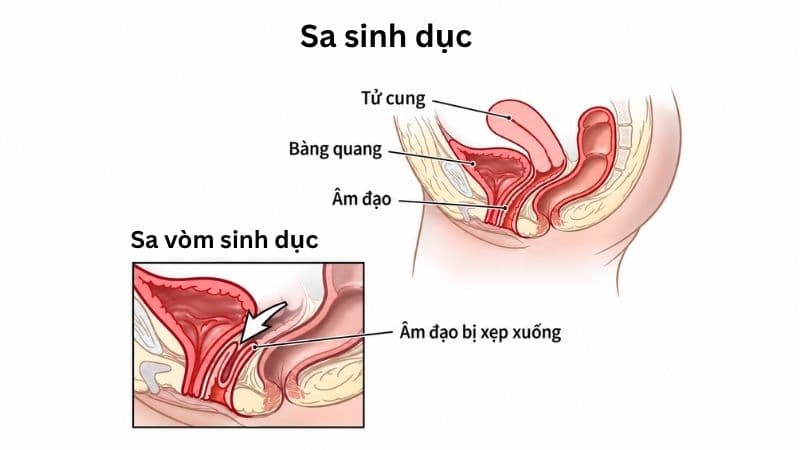Các phương pháp cận lâm sàng hỗ trợ đánh giá tổn thương, chức năng tiết niệu và các bất thường vùng chậu ở người bệnh sa sinh dục.