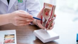 Trĩ nội độ 1: Dấu hiệu nhận biết, cách chữa và hướng điều trị
