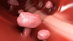 Adenoma nhung mao đại tràng là gì? Nguy cơ và cách điều trị