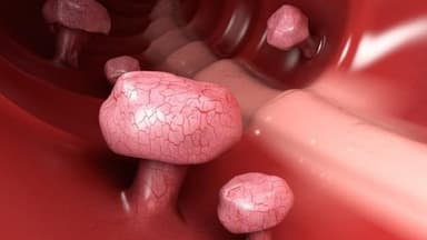 Adenoma nhung mao đại tràng là gì? Nguy cơ và cách điều trị
