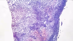 Adenoma ống nhung mao gây biến chứng gì? Cách điều trị và phòng ngừa ra sao?