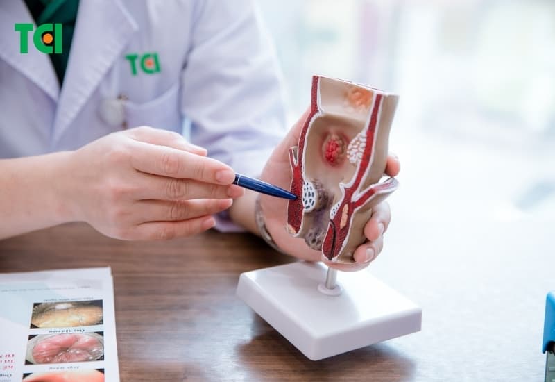 Áp lực kéo dài vùng hậu môn – trực tràng có thể thúc đẩy hình thành trĩ nội độ 1