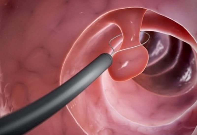 Bấm mẫu Adenoma làm sinh thiết để tầm soát ung thư đại tràng