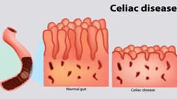 Bệnh Celiac là gì? Cách chữa bệnh hiệu quả