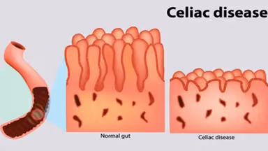 Bệnh Celiac là gì? Cách chữa bệnh hiệu quả