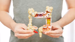 Phân biệt bệnh Crohn và viêm loét đại tràng khác nhau thế nào?