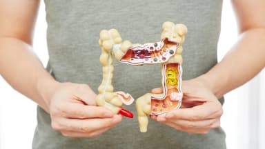 Phân biệt bệnh Crohn và viêm loét đại tràng khác nhau thế nào?