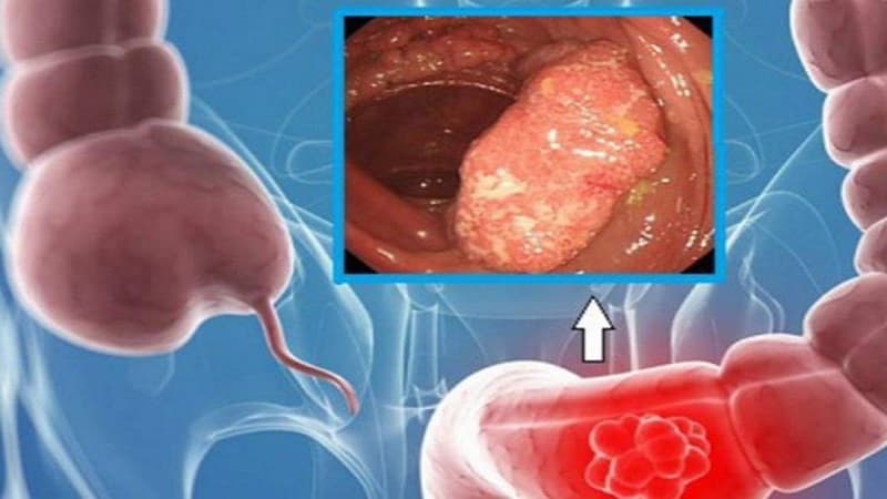 Chảy máu rỉ rả gây thiếu máu mạn tính