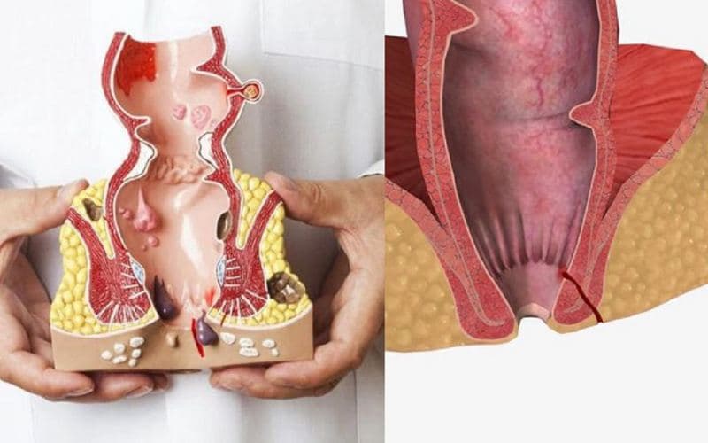 Giải đáp thắc mắc bệnh Crohn quanh hậu môn là gì