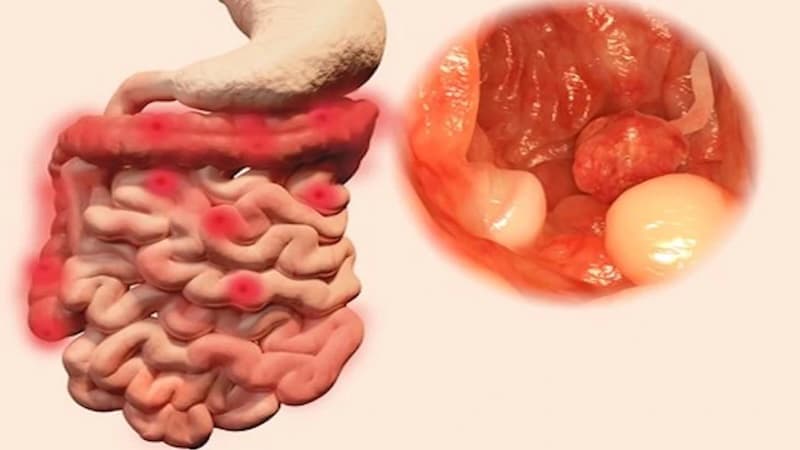 Theo dõi sau cắt polyp đại tràng để phát hiện sớm biến chứng nếu có