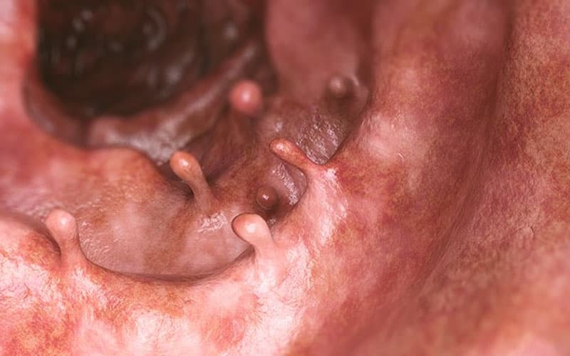 Polyp trực tràng có thể gặp nhiều kích thước khác nhau