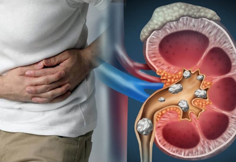 Biến chứng sỏi san hô có thể gây tắc nghẽn, thận ứ nước và ảnh hưởng chức năng thận nếu kéo dài