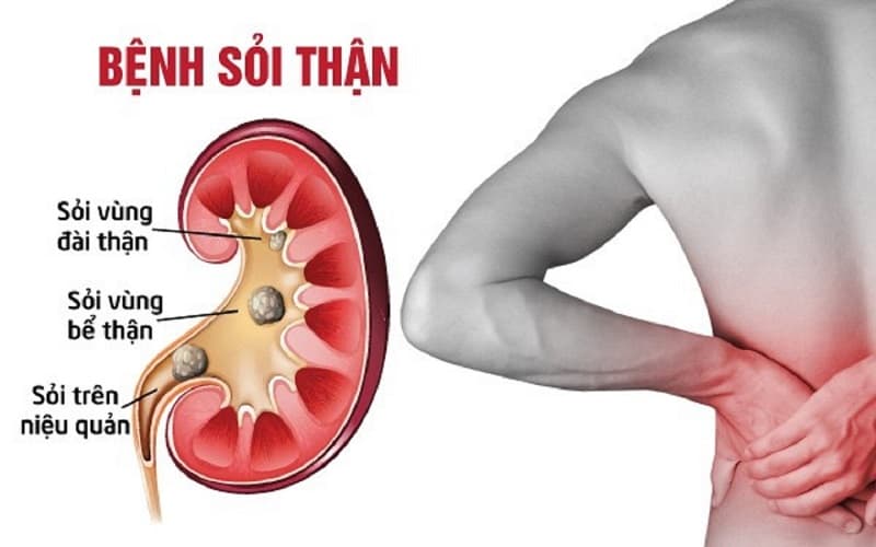 Sỏi thận kèm viêm bể thận là tình trạng người bệnh đồng thời có sỏi trong thận và viêm nhiễm tại bể thận