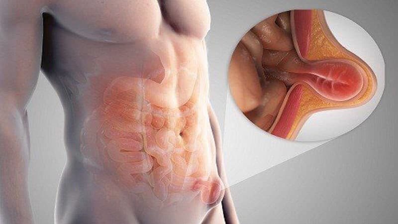 Thoát vị thành bụng là tình trạng một phần mô hoặc cơ quan trong ổ bụng đẩy qua vị trí cơ, cân hoặc mô thành bụng bị yếu