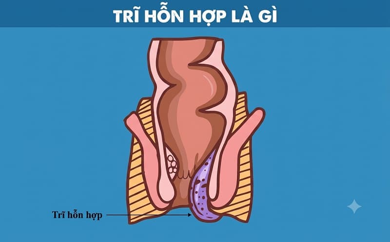 Trĩ hỗn hợp sa búi dễ nhận biết vì gây ra nhiều triệu chứng điển hình