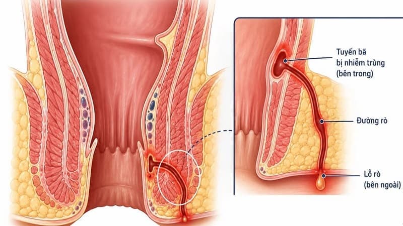 Viêm ống hậu môn kéo dài có thể xuất hiện lỗ rò