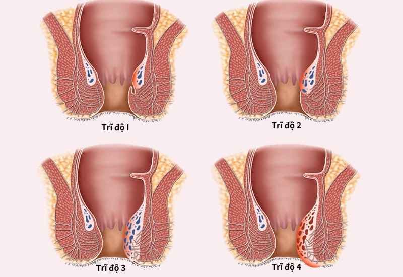 Búi trĩ sa ra ngoài khi đại tiện hoặc gắng sức, không thể tự co lên mà cần dùng tay đẩy vào trong