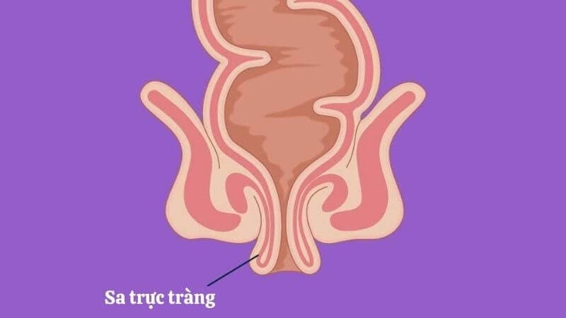 Sa trực tràng là tình trạng một phần hoặc toàn bộ thành trực tràng sa xuống, có thể lộn vào ống hậu môn hoặc sa ra ngoài qua lỗ hậu môn