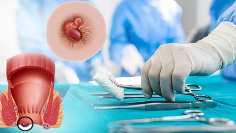 Mổ trĩ chảy máu có thể được cân nhắc khi búi trĩ lớn, sa nhiều, chảy máu kéo dài hoặc tái phát