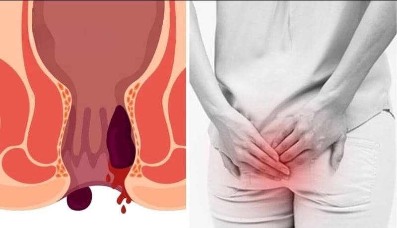 Trĩ nội độ 4 là giai đoạn tiến triển nghiêm trọng nhất