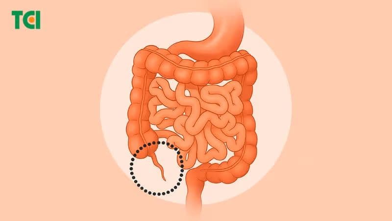 Viêm phúc mạc ruột thừa là biến chứng nguy hiểm của viêm ruột thừa