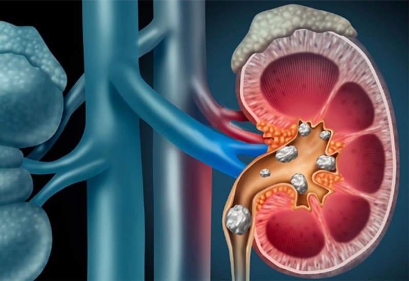 Chẩn đoán hình ảnh giúp xác định kích thước, vị trí và mức độ ảnh hưởng của sỏi