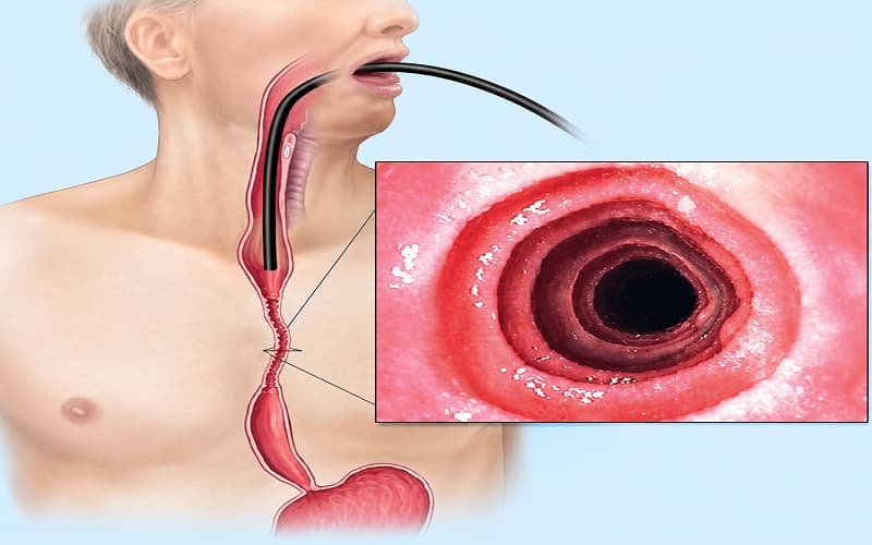 Nội soi chẩn đoán viêm thực quản tăng bạch cầu ái toan