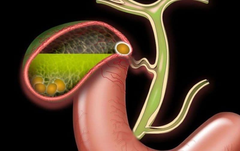 Viêm túi mật cấp tính là tình trạng túi mật bị viêm đột ngột, thường do sỏi mật gây tắc ống túi mật