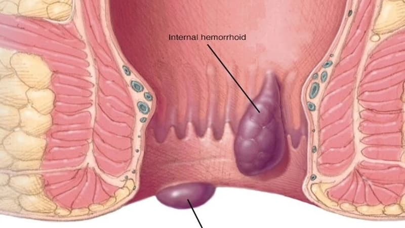 Trĩ tắc mạch là tình trạng hình thành cục máu đông bên trong mạch máu của búi trĩ
