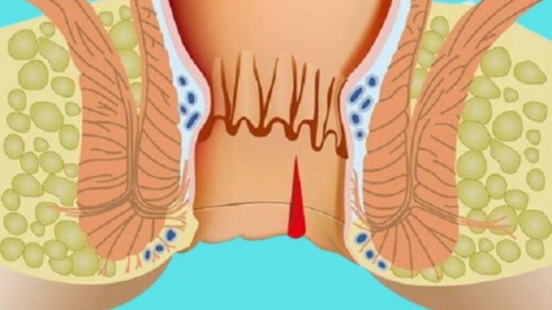 Nứt kẽ hậu môn là tổn thương dạng đường rách nhỏ ở niêm mạc hậu môn