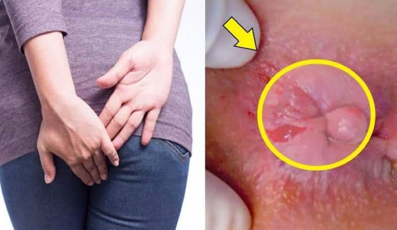 Trĩ ngoại là tình trạng các búi trĩ hình thành bên dưới đường lược (đường răng cưa) của ống hậu môn
