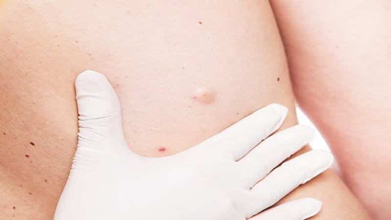 U bã đậu đa số lành tính và phát triển chậm