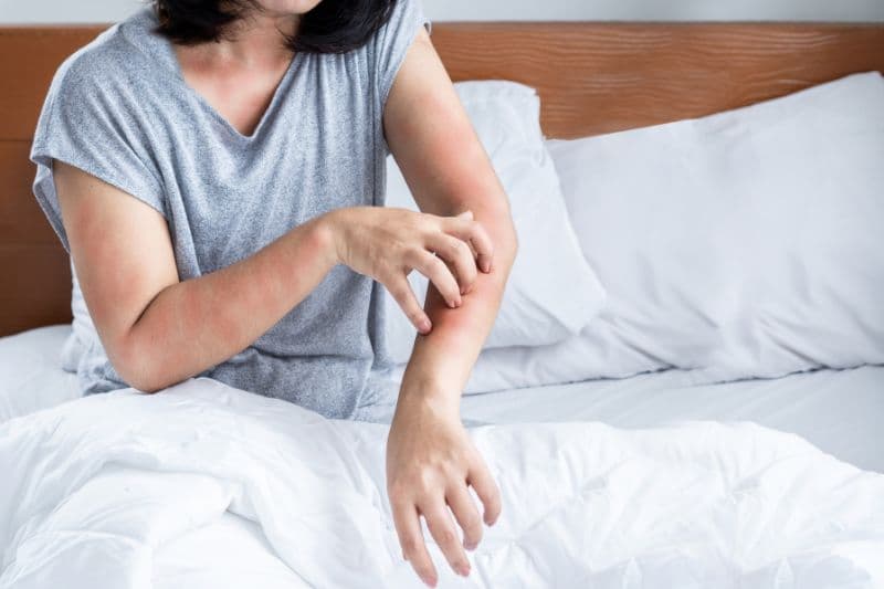 Mẩn ngứa là một trong những triệu chứng thường gặp ở những người bị bệnh gan ứ mật.