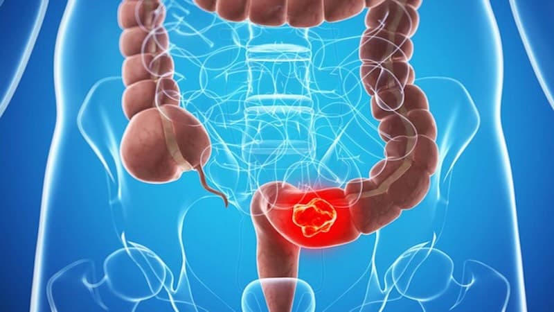 U tuyến đại tràng có chứa các tế bào loạn sản
