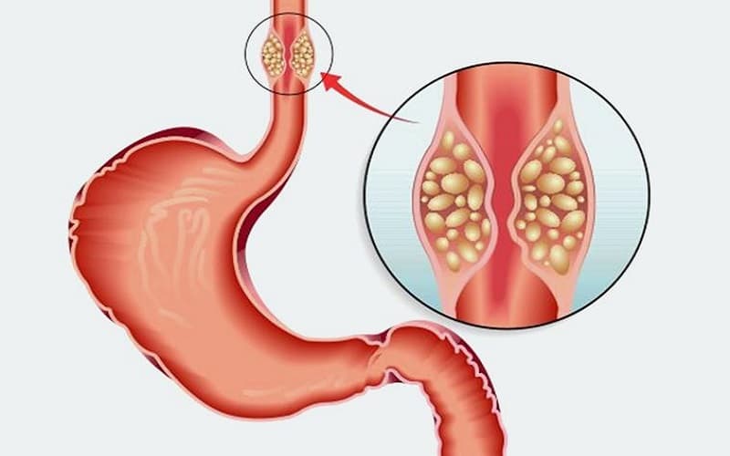 Tiến triển bệnh theo từng giai đoạn cụ thể