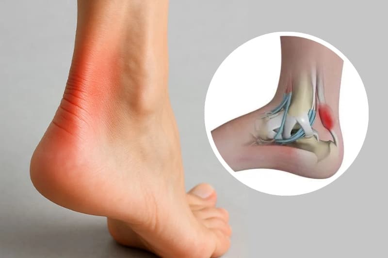 Tình trạng viêm xuất hiện khi dải gân bị tổn thương