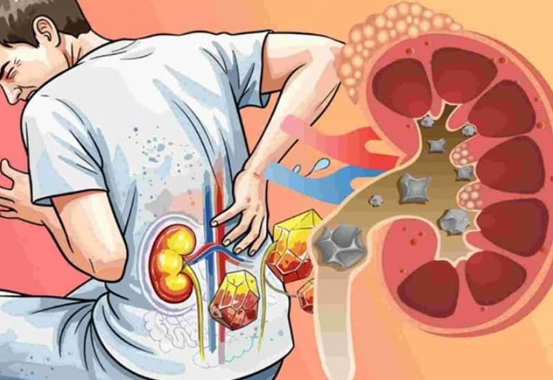Đau hông lưng, tiểu buốt, tiểu máu hoặc sốt là những dấu hiệu người bệnh không nên chủ quan