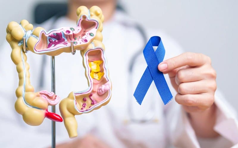 Một vài thông tin cần biết về ung thư trực tràng thấp