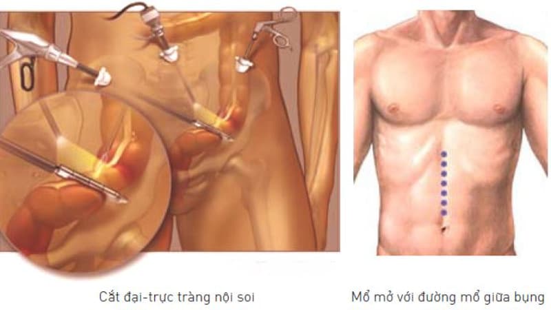 Phẫu thuật cắt bỏ đại tràng khi nghi ngờ ung thư xâm lấn