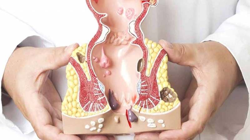 Nứt kẽ hậu môn là tình trạng xuất hiện vết rách nhỏ ở lớp niêm mạc hoặc da ống hậu môn