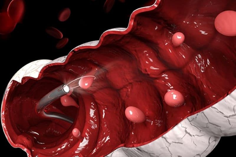 Điều trị polyp dạ dày phụ thuộc vào loại polyp, kích thước, đặc điểm mô bệnh học và nguy cơ tiến triển thành ung thư