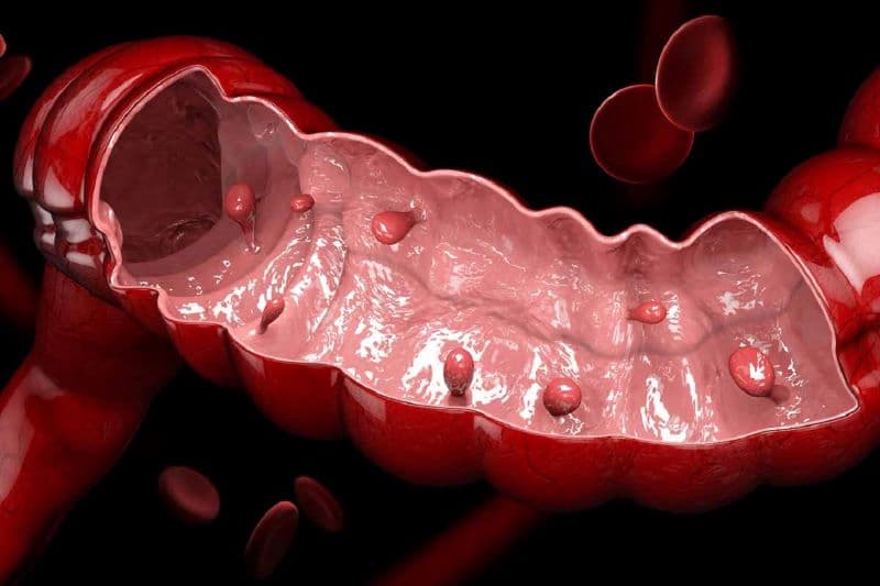 Polyp đại tràng sigma là tình trạng mô niêm mạc phát triển bất thường, tạo thành khối lồi trong lòng ruột