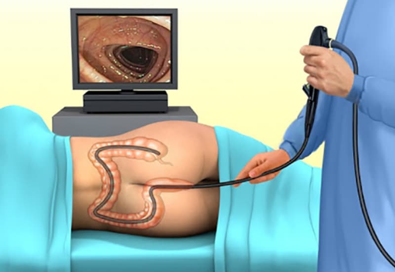 Nội soi đại tràng phát hiện polyp manh tràng
