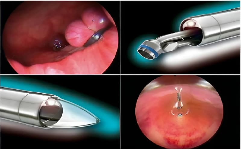 Cách điều trị trĩ nội chảy máu cho từng mức độ bệnh