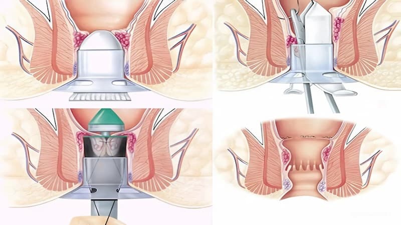 Có nhiều phương pháp chữa trị trĩ nội độ 4