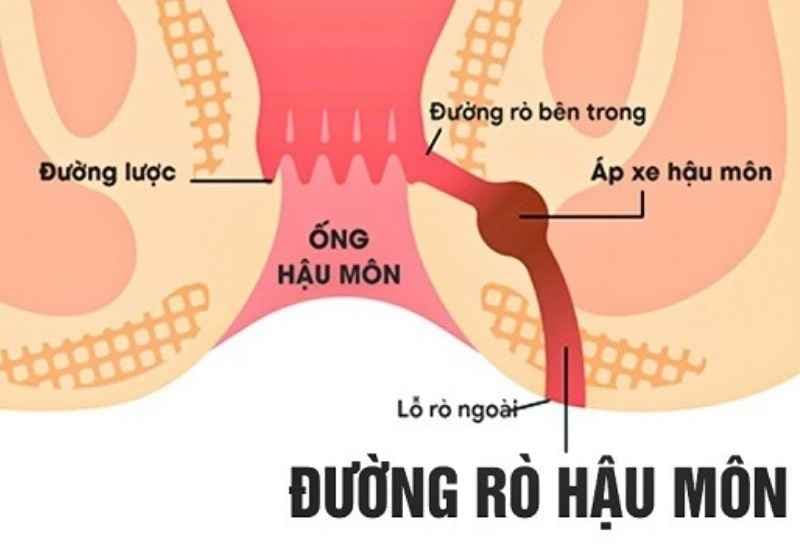 Đường rò bất thường nối ống hậu môn với vùng da bên ngoài thường hình thành sau nhiễm trùng hoặc áp xe quanh hậu môn
