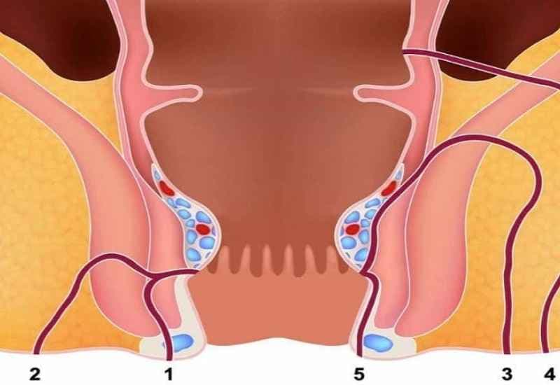 Đường rò có thể phân thành nhiều nhánh, đi sâu qua cơ thắt hậu môn và gây nhiễm trùng tái phát